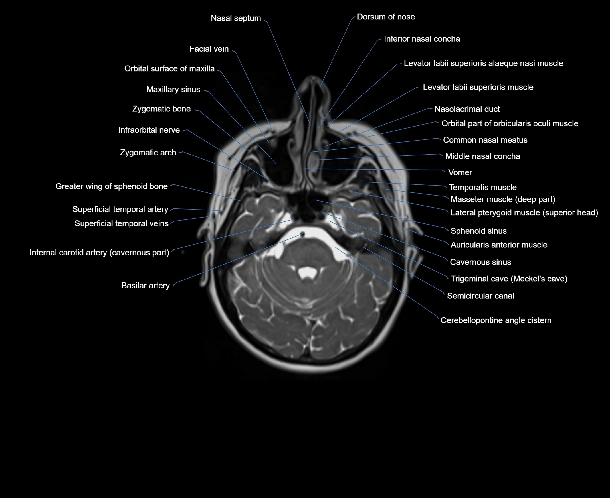 MRI Neck 3D labelled cross section anatomy axial 3t image-00001-00006.webp